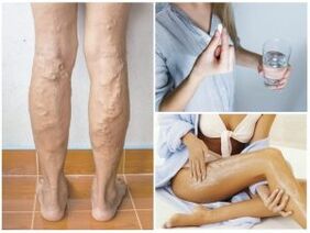 Venas varicosas en las piernas y métodos de tratamiento