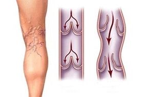 Salida de sangre en las venas varicosas en diferentes etapas del desarrollo de la enfermedad.